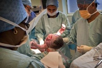 实拍剖腹产宝宝出生瞬间