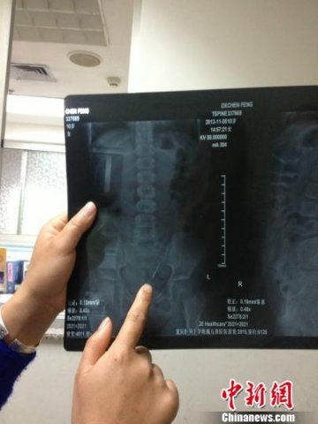 10岁女孩误吞绣花针 医生称可随大便排出