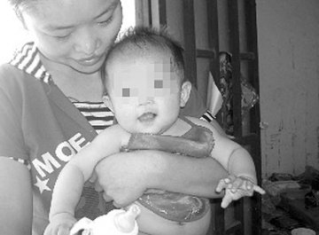 女婴生有12根手指和12根脚趾