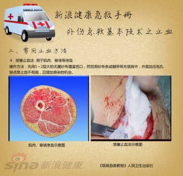 常用止血方法：填塞止血法