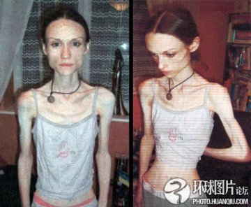 盘点：惨不忍睹的减肥后遗症