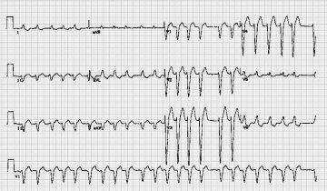 心房纤颤伴左束支阻滞Atrial fibrillation with pre-existing LBBB