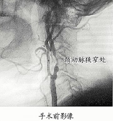 颈动脉狭窄手术立竿见影