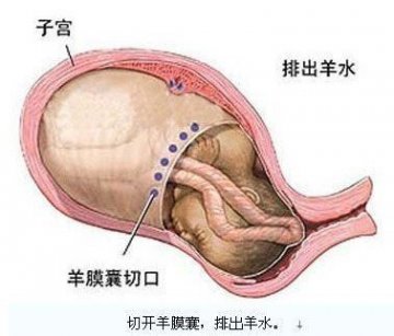 医学实录：女性剖腹产手术全过程