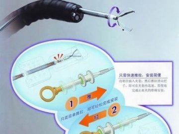 军医科普：“吐”出来的毛病 贲门黏膜撕裂综合征