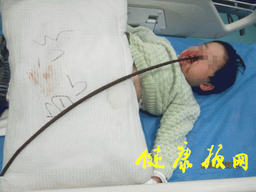临床快递：钢筋刺入五岁幼童头部，湘雅医院施救化险为夷