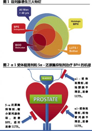 抗前列腺增生药呼唤新品
