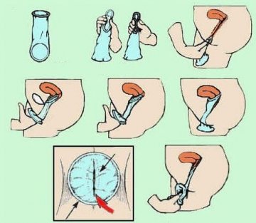 性福春节：女性新式避孕方法大全