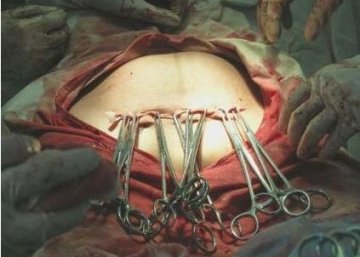 人体探秘：实拍剖腹产震撼生产过程