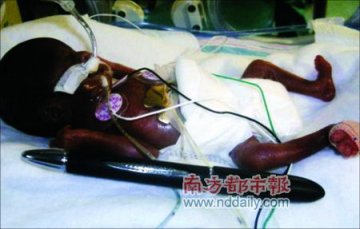 24厘米早产儿健康存活