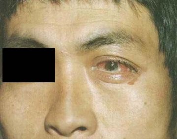 淋病性结膜炎