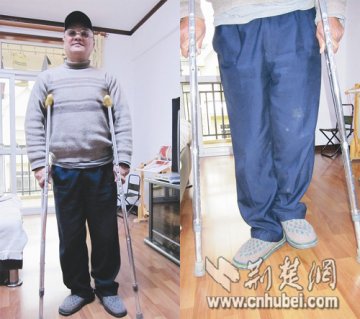 老人换骨失败致残 医院承认人造骨来自不法医商