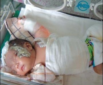 24天男婴在医院内重度烧伤可能严重毁容