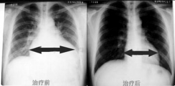 扩张型心肌病应及时治疗