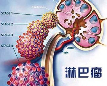 恶性淋巴肿瘤的常识及科学治疗方法
