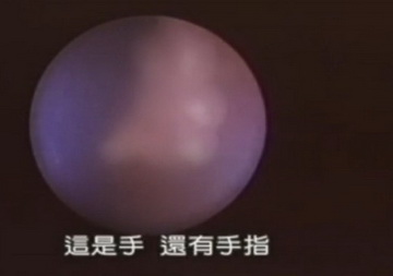 实拍少女人流全过程