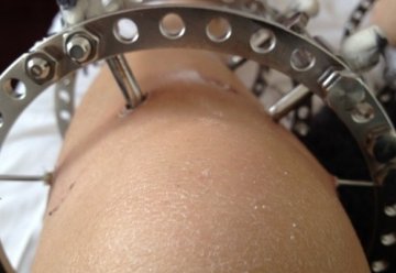 女子为矫正O型腿 在腿上钉螺丝