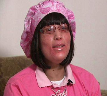美国女子全身毛囊不长毛发长指甲