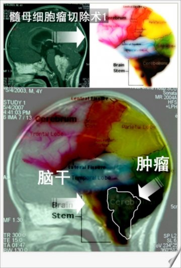 髓母细胞瘤手术