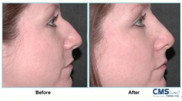 西美斯鼻部整形让你的容颜更出众