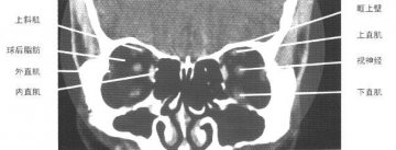 正常眼眶CT（4）