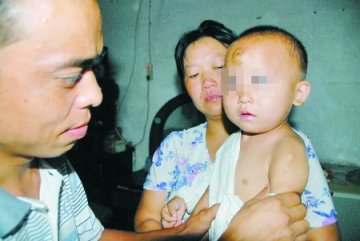 男童患罕见石人综合征 被碰后肉变硬成为骨头