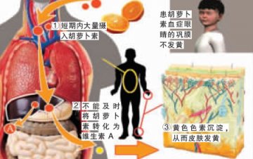 11岁男孩橘子吃太多全身变橘黄色