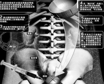 首次移植克隆膀胱像作夹心蛋糕图