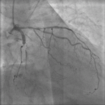 经桡动脉闭塞病变的PCI