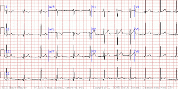 左右手反接（Limb lead reversal）