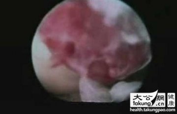 神奇的生命：实拍女性排卵真实过程