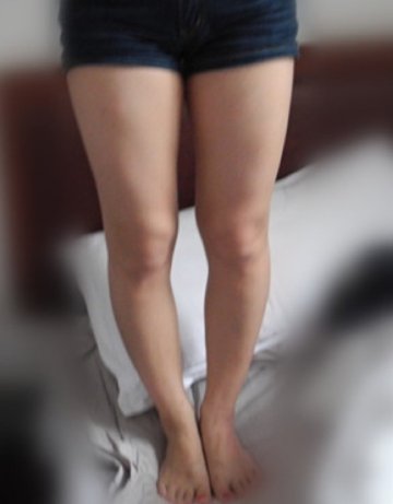 女子为矫正O型腿 在腿上钉螺丝
