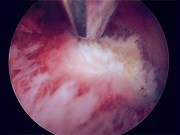 强生召回腹腔镜高能粉碎器 因其或导致癌症扩散
