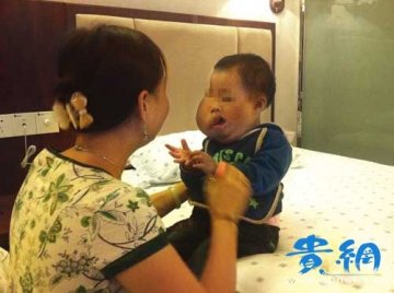 3岁男孩脸部患肿瘤被弃高速路