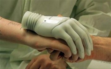 奥地利男子切除坏手装仿生手 有望完成精细动作