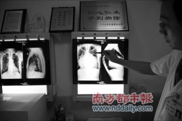 巨心人胸骨脊椎都被心脏