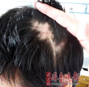 医院实施开颅手术弄丢患者颅骨