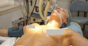 国外隆胸手术全过程实拍