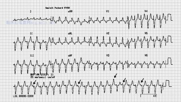 室速伴明确的房室分离Ventricular tachycardia with clear AV dissociation