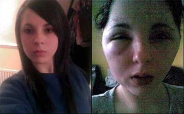 英少女用染发剂遭毁容变外星人图