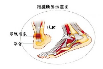 跟腱断裂“逼着”刘翔退役