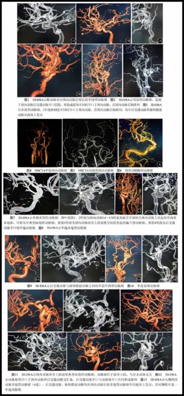 顾建文：颈内动脉瘤构型的CT与三维DSA重建成像