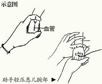 新生儿手背静脉采血技巧