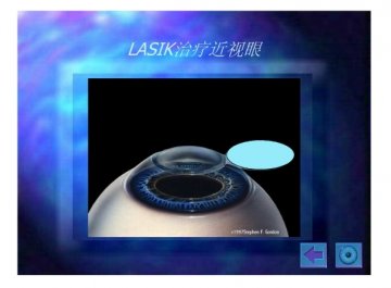 lasik11
