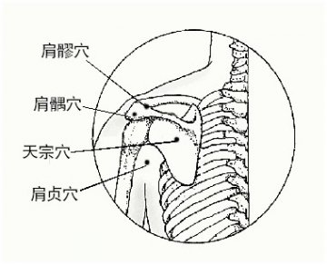 治肩周炎重在舒筋通络
