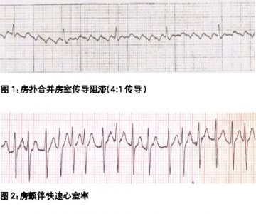 心房扑动和颤动