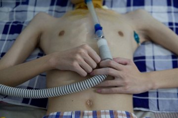 庞贝氏病患者带着呼吸机的生活