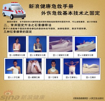 几种石膏绷带的固定