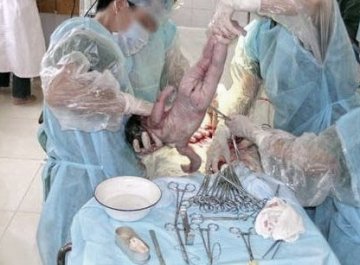 人体探秘：实拍剖腹产震撼生产过程