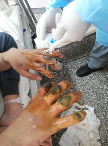 沾益一少年戒网瘾 被捆绑吊单杠8根手指坏死